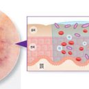 멍 드는 이유 & 멍 빨리 빼는법, 피멍 빼는법 (멍색깔, 노란멍) 이미지