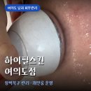 하이필스킨 | 여의도 남자 피부관리 하이필스킨 여드름 좁쌀 관리 후기