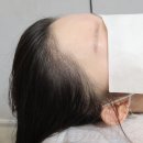 미헤어라인 이미지