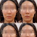 재정한의원 | 강남한의원 턱관절 안면비대칭 전문| 침 없이 부드럽게 교정 전후 후기