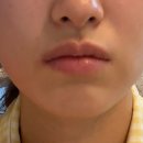 서울정치과의원 | [인천/구월동] 무조건 사랑니는 여기서 빼세요!😷🦷 | 서울이턱사랑니치과의원 내 돈 내산 후기 및 비용👍👍