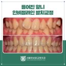 서울하상운치과교정과치과의원 | 틀어진 앞니 배열을 위한 분당 교정치과 인비절라인 발치 교정