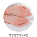 달리거나 오래 걷기 힘든 평발 편평족의 원인 증상 및 교정 치료 방법 이미지