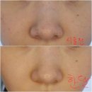 루비약국 | 압구정 루비레이저 병원 내돈내산 후기부터 전후사진 및 한달후기까지 총정리✨