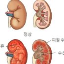 만성 급성 신우신염 원인 이미지