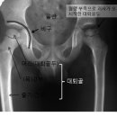 넓적다리 뼈머리가 썩는다 - 무혈성괴사 이미지