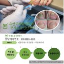 유앤미의원 | 고양 화정 발톱무좀 집에서 무좀약 바르면 낫나요? 5개월 무좀 치료 변화 직접 보세요 (행신 유앤미)