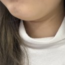 기린성형외과의원 | 기린성형외과의원 이중턱 시술 갸름주사 1회차, 2회차 후기