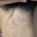 장미꽃과나이팅게일외과의원 | [7개월 후 후기, 비용] 수원 표피낭종 제거, 장미꽃과나이팅게일외과