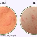 음식과 질환 - 두드러기 이미지