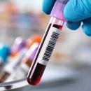 암종별 종양 표지자(Tumor Marker)의 정상 수치 ​ 이미지