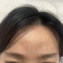 원주리라 | 내돈내산 원주스노우의원 미간 보톡스 맞은 후기