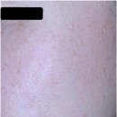 써마지600샷 받기 전 알면 좋은 3가지(송도 써마지 치료 가이드 _ 실제 사례 포함)