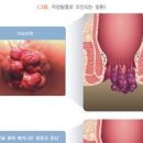 직장탈출증 후 재발 예방 관리법 이미지