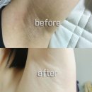 사라약국 | 겨드랑이 약국 착색크림 색소침착 레이저 홈케어 추천템