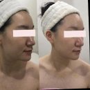 홍대피부관리, 예본에서 경험한 맞춤형 피부 관리로 피부 회복 시작!