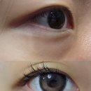 멍베스트 | 눈밑지방재배치 후기 : 붓기,멍, 일상생활(+기간별 사진, 병원)
