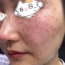 삼아제약(주) | [블챌] 5주차 스페셜 - 루비레이저 잡티, 주근깨 또주기기 깨털이범 루비레이저주의사항