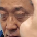 [내돈내산] 상한검, 하안검 수술상담 세부후기