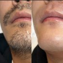 J여성사우나 | 굵은 수염 정리 끝! 안성 J왁싱 &amp; 뷰티 남성 면도왁싱...After |면도왁싱, 한 번에 깔끔하게! 리얼 후기