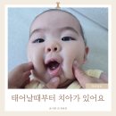 신생아치아 태어날때부터 선천치 원인 소아치과 내원 시기