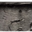 Liver hemorrhage/Hematoma 이미지