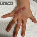 푸른마음정신과의원 | [화상 치료 후기-3] 어린이 심재성 2도 화상 2-3주차...화상 치료 전문 삼성올바른외과의원, 칼로덤 드레싱