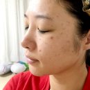 여드름 압출 하지 마세요! 개기름엔 중학생 여드름 피부 화장품 쓰세요! 이미지