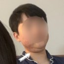 경주피부과 추천 인모드 찐후기 바로그의원