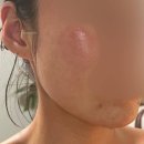 하나로약국 | 세비타비겔 한 달 후기, 약국 여드름 연고 색소침착 효과 진짜 있었다