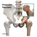 [대퇴골두무혈성괴사] 지나친 음주가 '고관절 뼈 괴사' 부른다 이미지
