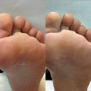 수원-1332 | 광교 발각질/무좀 관리 추천 레푸스 수원광교점 김수민 푸스플레게 솔직후기