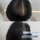 미인축산 | 영등포탈모 여성정수리 커버 스테이션SMP&Dot 3회차 후기