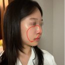 쥬베룩볼륨 앞볼 꺼짐, 팔자 2회차 후기 — 통증·붓기 전후사진 (영등포피부과 내돈내산)