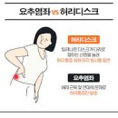 급성 요추염좌 / 허리염좌 (골반 허리 다리 통증) 이미지