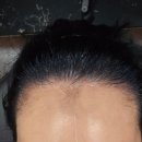 채움 | 두피 채움 후기! 넓은 M자 이마 두피 문신으로 채워주는 위브로 솔직후기!