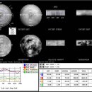 국시2차영상 Tl 201-Myocardium scan 이미지