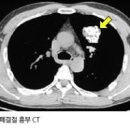 고립성 폐결절 원인 증상 양성 악성 구분 폐암 일수도 이미지