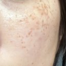 에이메디팜 | 광주 주근깨 기미 흑자 레이저 후기(1회차)