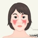 '루푸스' 병....조기발견이 중요 이미지