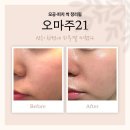 천안두정초등학교 | 천안 피부관리 효과 본 곳 오마주21 두정동 후기 (여드름 압출 모공관리)