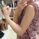 차 | [내돈내산] 팔뚝+겨드랑이(부유방) 지방흡입 2주차 후기