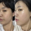 200 | 서면피부과 텐쎄라 200라인 후기