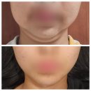 블루밍의원 | 명동역 을지로피부과 블루밍의원 이중턱 윤곽주사 은방울주사 다이어트 효과