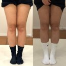 진은이발 | 인천지방분해주사 효과좋은 곳 예비신부의 찐추천 구월동 H의원 5주차 솔직후기