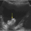 Bladder tumor. 이미지