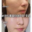 강남역여드름흉터 올인원레이저로 말끔해진 피부 후기