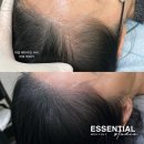 에센셜스튜디오 SMP | 고양시 가르마 탈모 고민, 여성 SMP 시술 전후 이야기