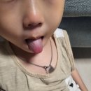 호텔38.5℃ | [육아/가와사키병] 가와사키병 치료 수기