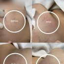 셀리 | 분당여드름압출 솔직후기ㅣ셀리올리스킨랩 정자점 여드름관리 전후비교